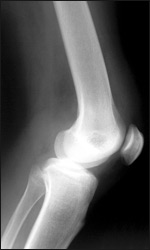 Röntgenbild eines Knies